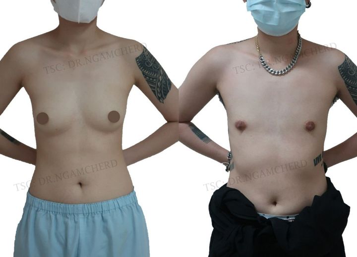 Transman Top Surgery