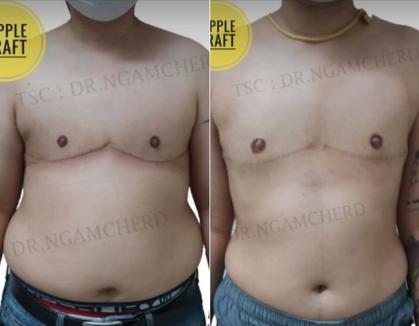 Transman Top Surgery