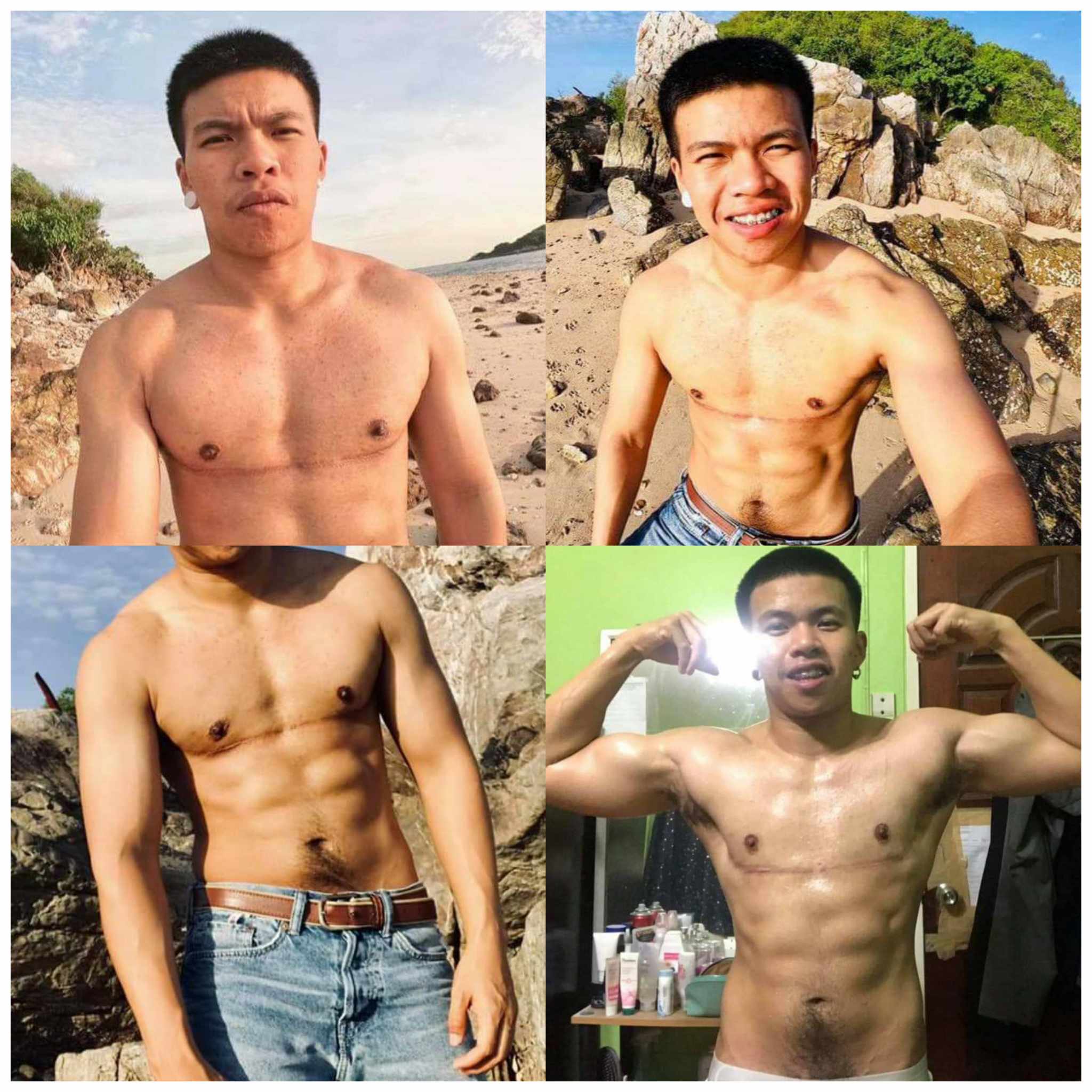 One of the FTM Top Surgery result by Thailand surgeons